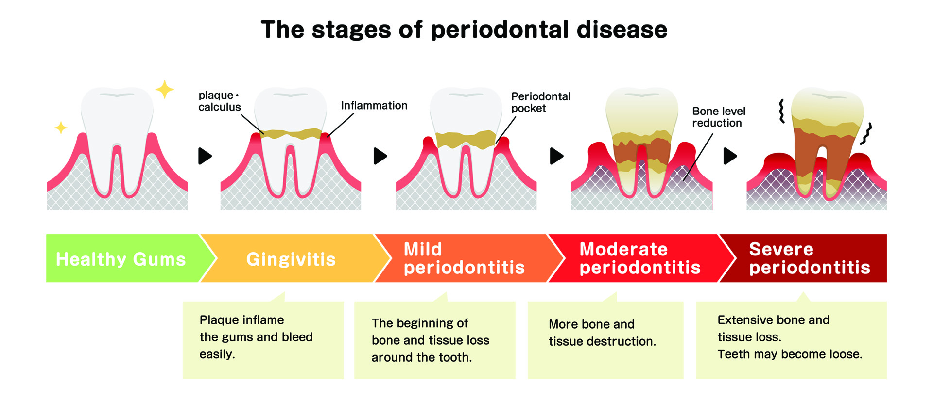 Lake Street Dental | Veneers, Teeth Whitening and Root Canals